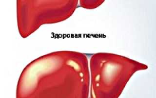 Астеновегетативный синдром при хроническом гепатите