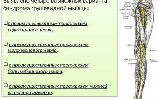 Лечение синдрома грушевидной мышцы мазями