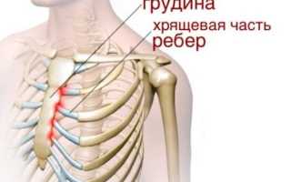 Народное лечение синдром титце симптомы