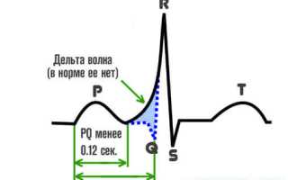 Что означает синдром укорочения на экг