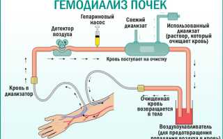 Программный гемодиализ код мкб