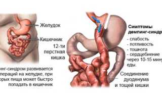Демпинг синдром у неоперированных что это такое