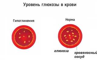 Код по мкб гипогликемия при сахарном диабете