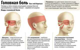 Синдром вегетативных дисфункций с цефалгиями по смешанному типу