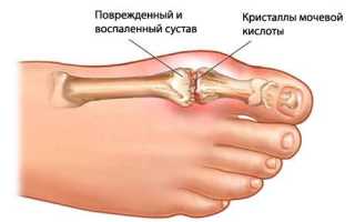 Тофус код по мкб 10
