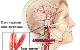 Дисциркуляторная энцефалопатия 2 степени с атактическим синдромом