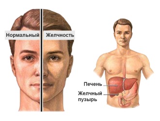 Синдром Жильбера: симптомы болезни, причины и лечение