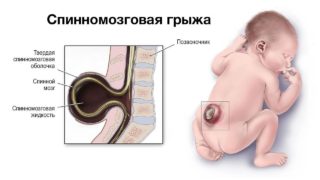 Врожденная спинномозговая грыжа код мкб