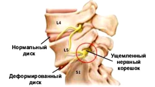 Стандарт лечения остеохондроза позвоночника с корешковым синдромом