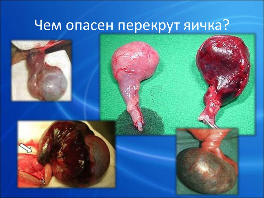 перекрут яичка