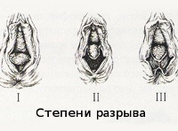 Разрыв промежности