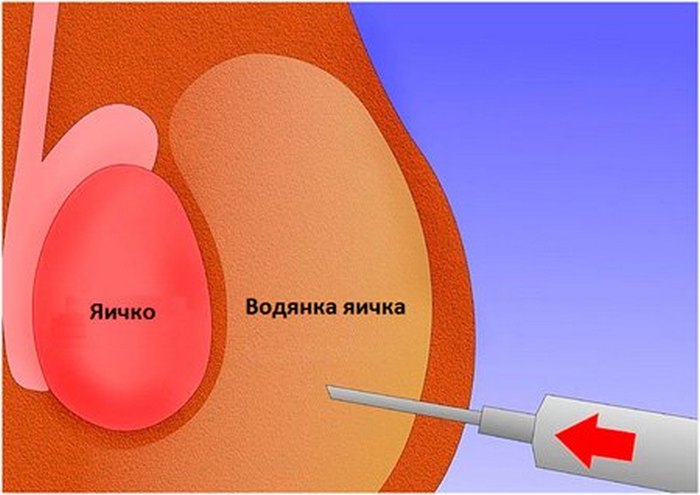 водянка оболочек яичек
