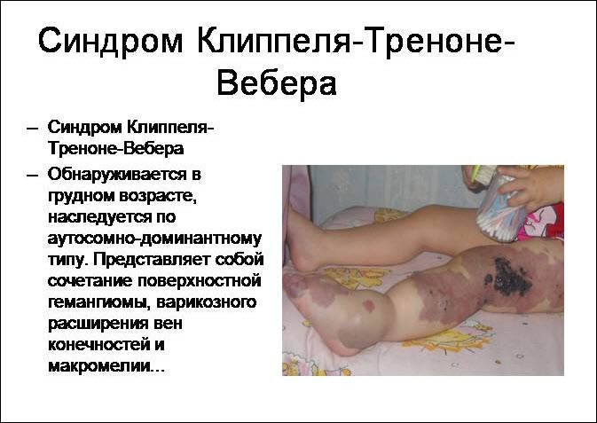 Сто такое синдром Клиппеля-Треноне 