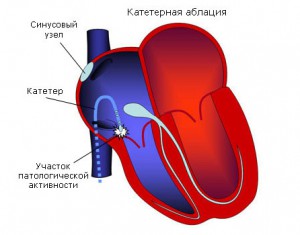 Что означает синдром укорочения на экг