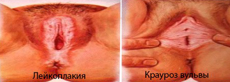 Крауроз код мкб 10