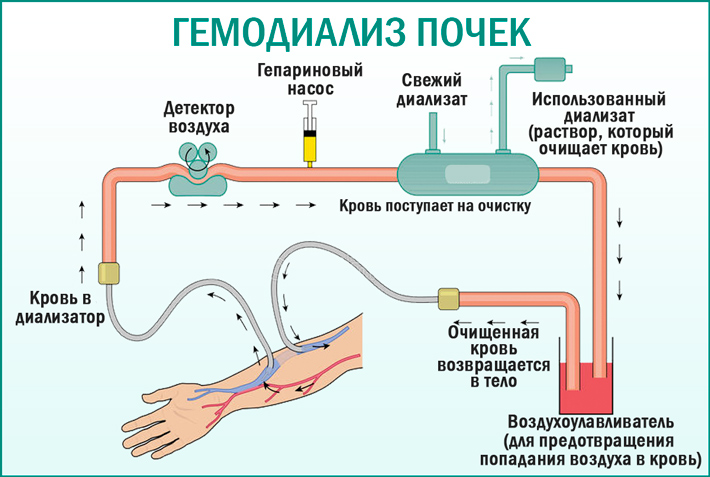Гемодиализ: показания