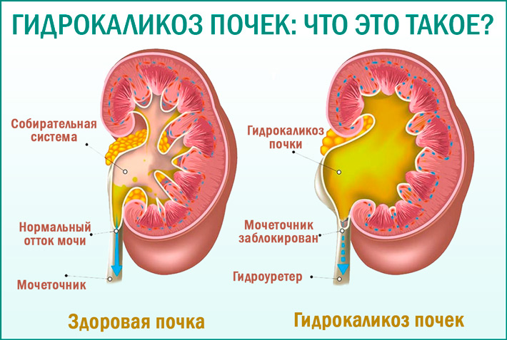 Что такое гидрокаликоз почек?