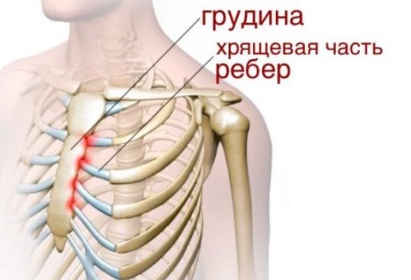 Народное лечение синдром титце симптомы