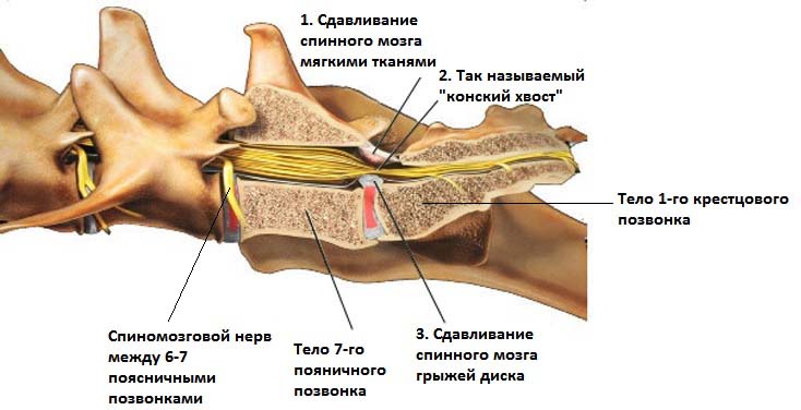Пояснично-крестцовый стеноз
