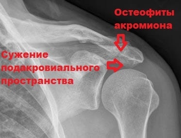 Импиджмент синдром правого плечевого сустава лфк