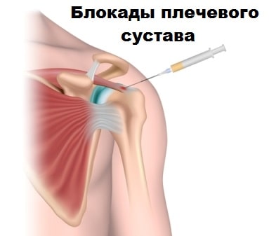 Импиджмент синдром правого плечевого сустава лфк