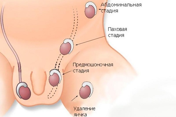 Визуализация крипторхизма