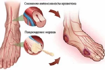 Диабетическая ангиопатия