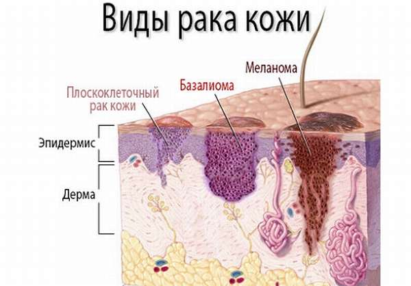 Мкб код рак плеча