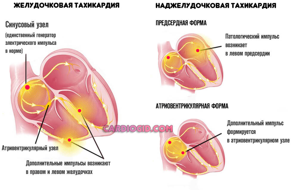 тахикардия наджелудочковая и желудочковая