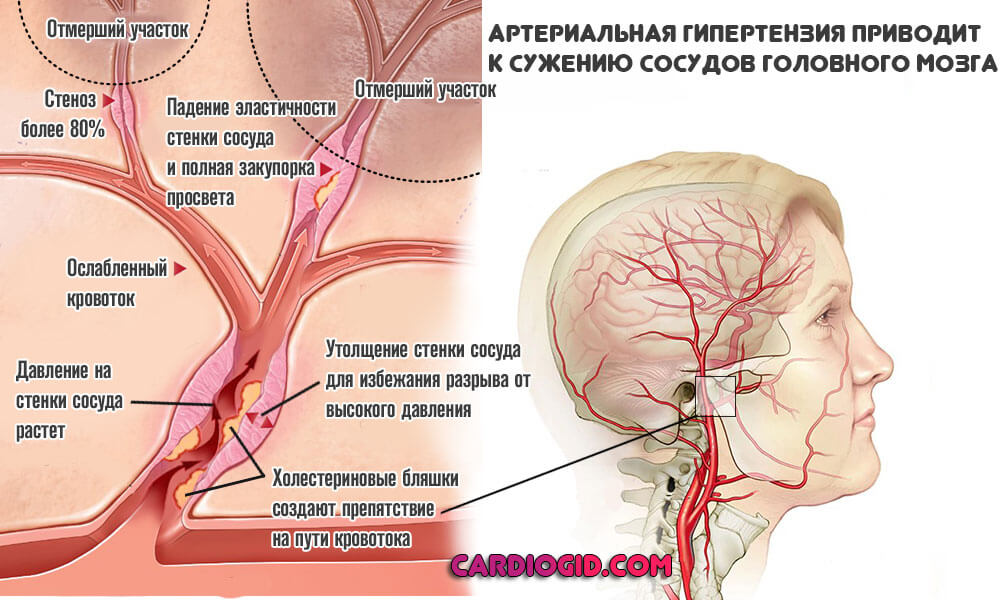 Дисциркуляторная энцефалопатия 2 степени с атактическим синдромом
