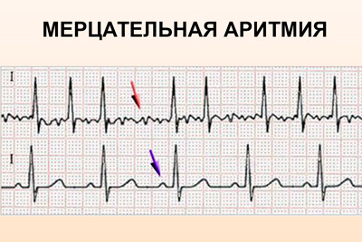 Мерцательная аритмия на ЭКГ