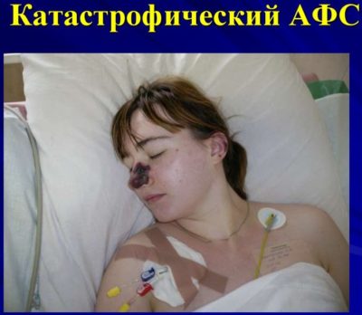 Подготовка к родам при антифосфолипидном синдроме