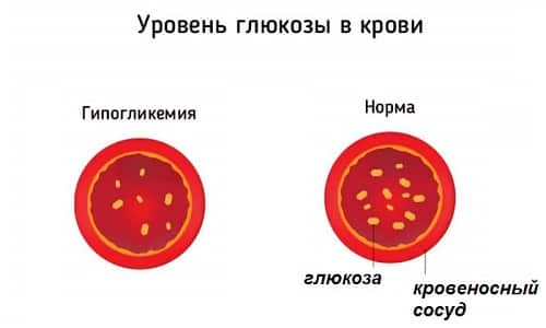 Гипогликемия - это состояние, при котором происходит понижение уровня глюкозы в крови