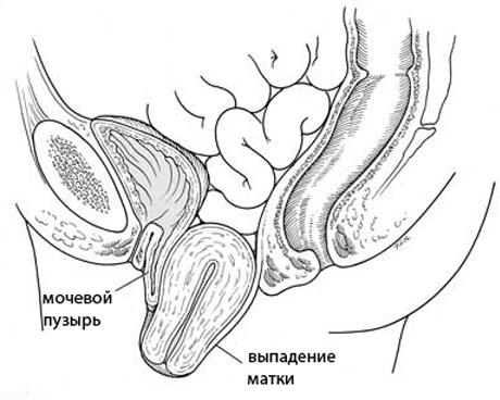 Выпадение (опущение) матки