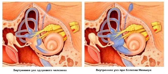 Синдром и болезнь меньера симптомы