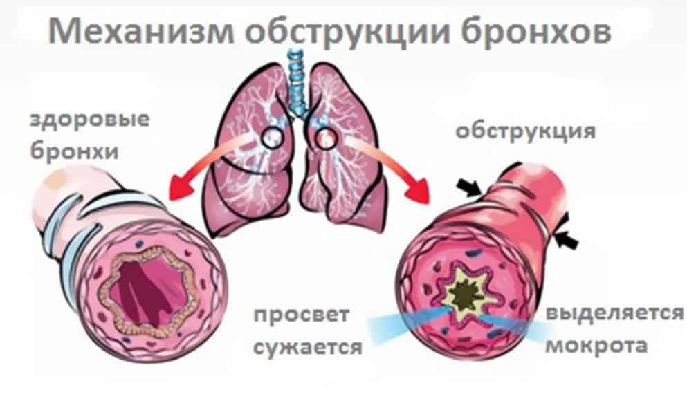 Воздух с трудом поступает в легкие по суженным бронхам